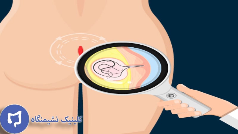 عکس دوران نقاهت بعد از عمل کیست مویی