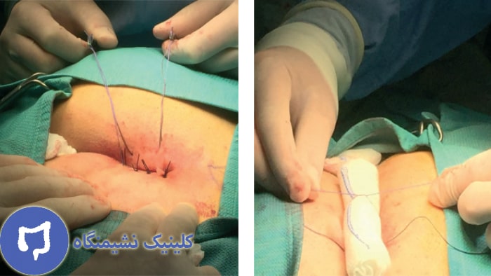 عکس جراحی کیست مویی