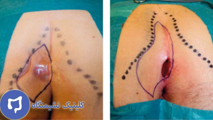 عکس درمان کیست مویی با دارو و پماد