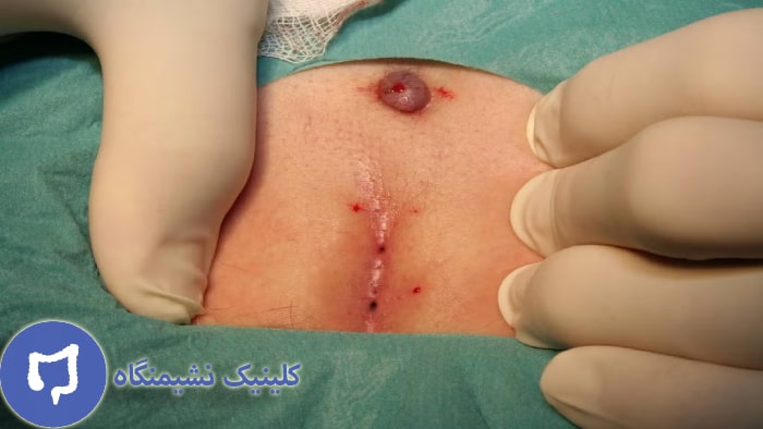 عکس پماد برای کیست مویی