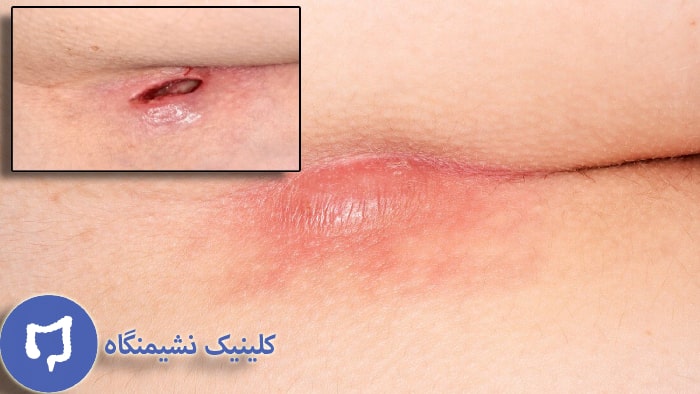 عکس ترشح بعد از عمل کیست مویی