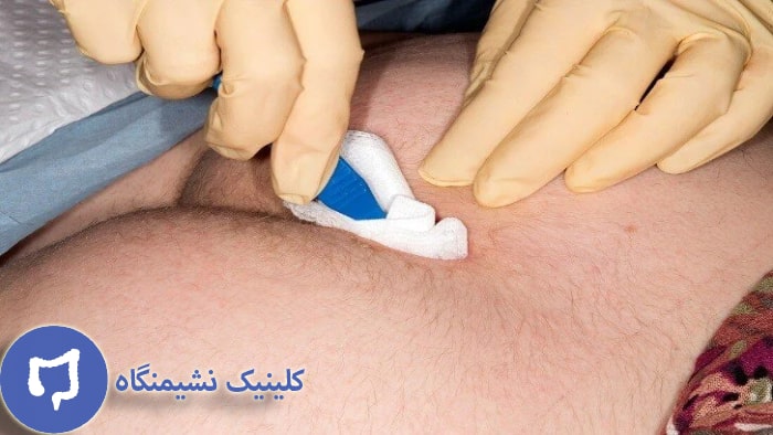 عکس تعویض پانسمان کیست مویی