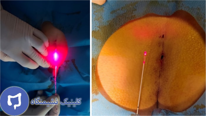 عکس عمل کیست مویی