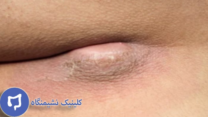 عکس کیست پیلونیدال