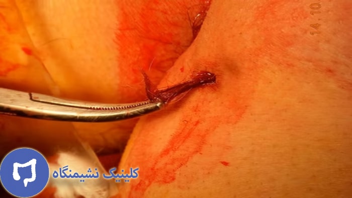 عکس درمان کیست مویی با لیزر