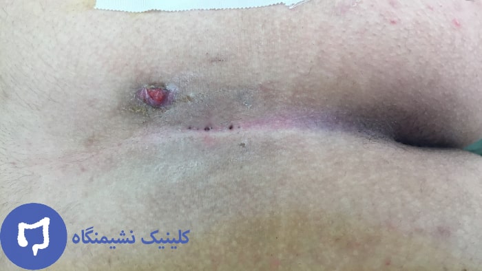 عکس کیست مویی درمان شده