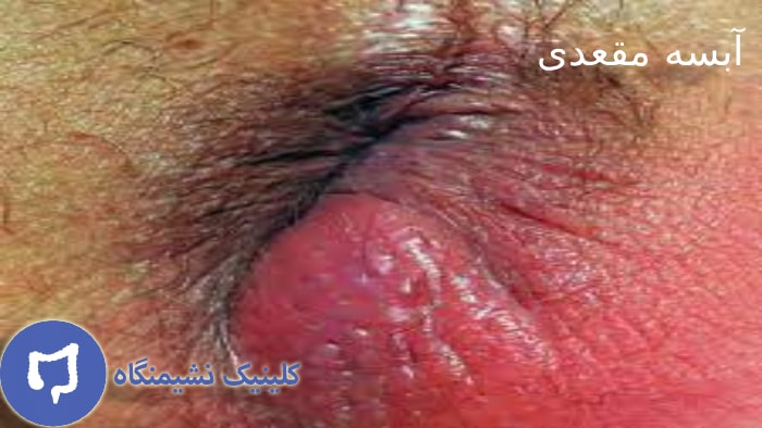 عکس تشخیص آبسه مقعدی