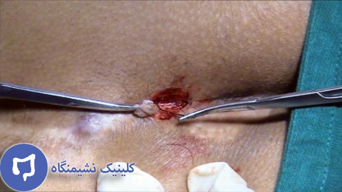 عکس درمان عود کیست مویی