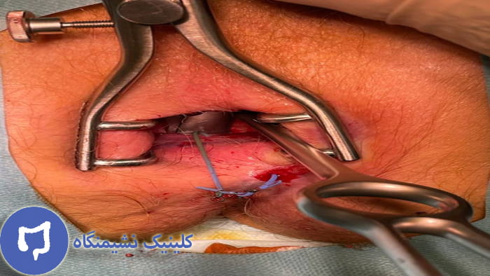 عکس پیشگیری از تشکیل فیستول نعل اسبی