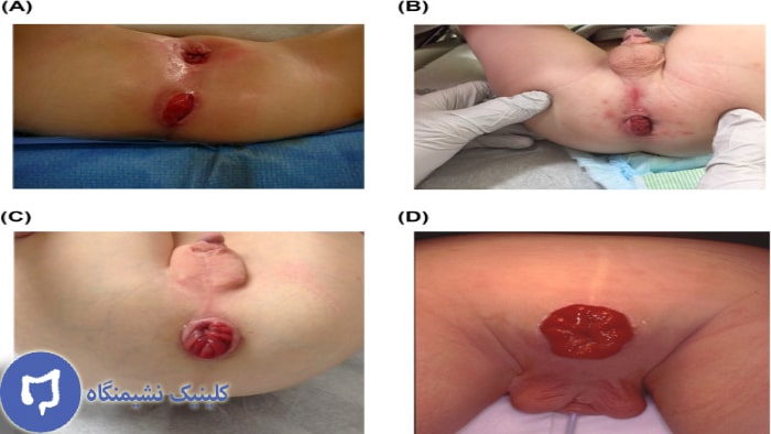 عکس بیرون زدگی مقعدی