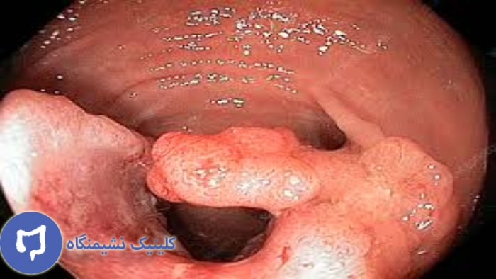 تصویر از سرطان مقعدی