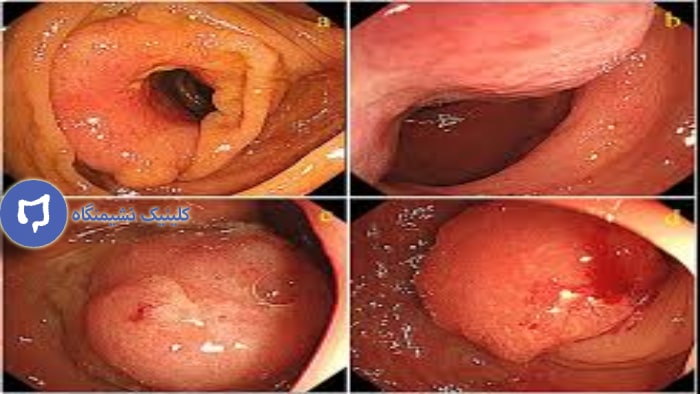 عکس مشکلات رکتوم