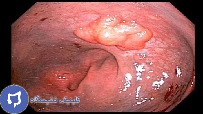 عکس پولیپ مقعد