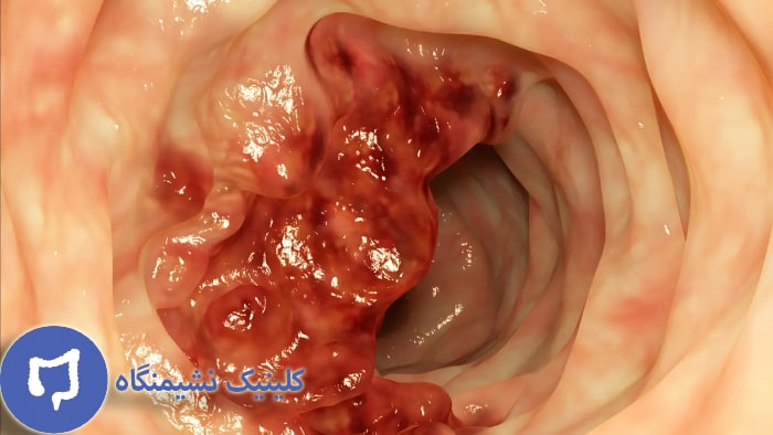 عکس بیماری در مقعد