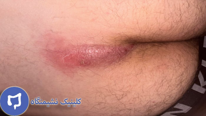 تصویر کیست مویی عود کرده