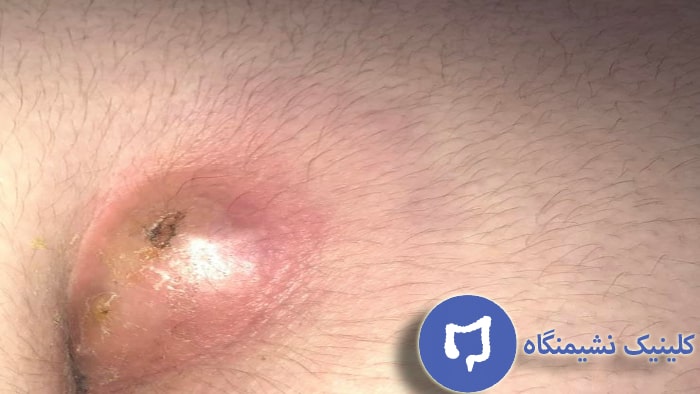 عکس کیست مویی عود کرده