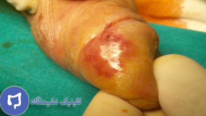 عکس روش درمان زگیل تناسلی