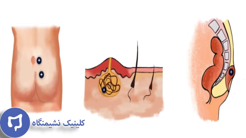 عکس عود کیست مویی