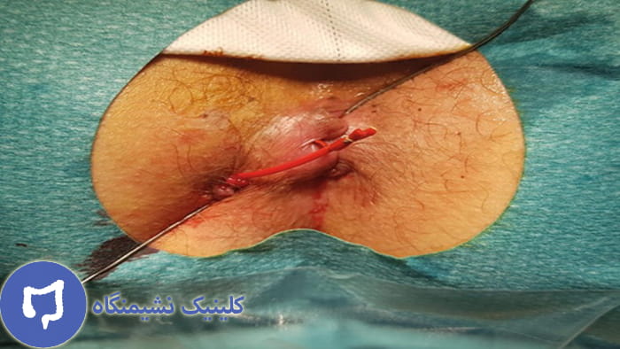 عکس علائم فیستول مقعدی پیشرفته