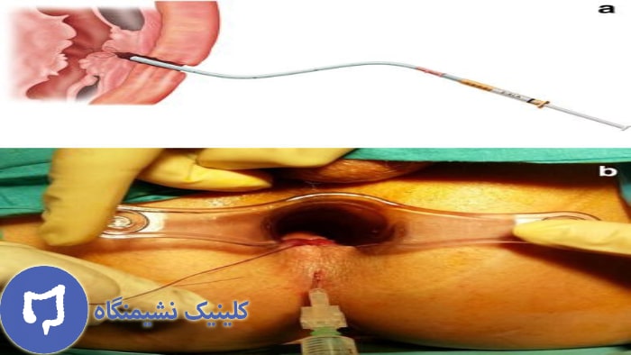 عکس فیستول آنال