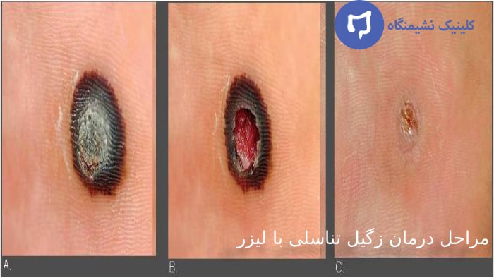 عکس لیزر زگیل تناسلی