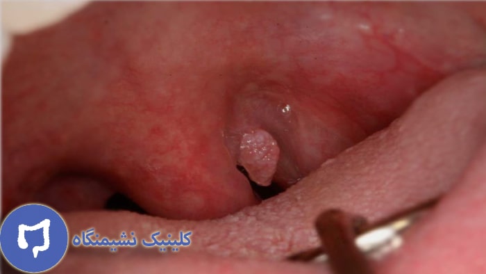 عکس زگیل دهانی