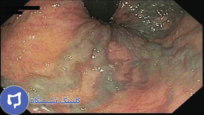 عکس بواسیر داخلی ترومبوزه شده