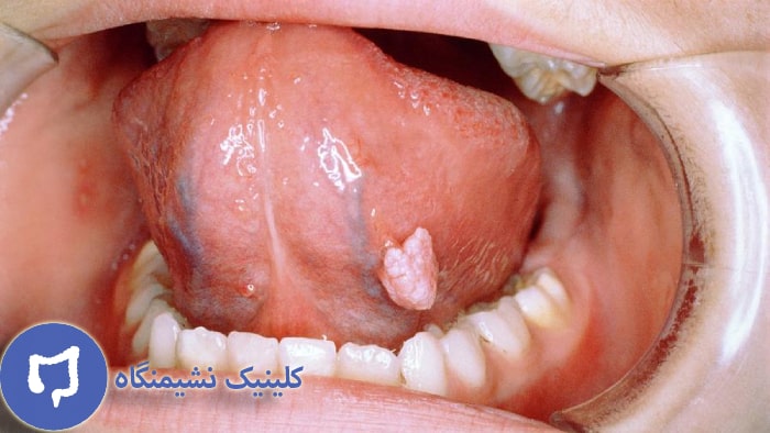 عکس زگیل زبان