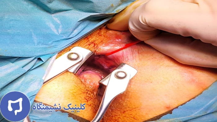 عکس فیستول مقعدی