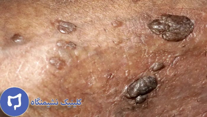عکس زگیل تناسلی در مردان