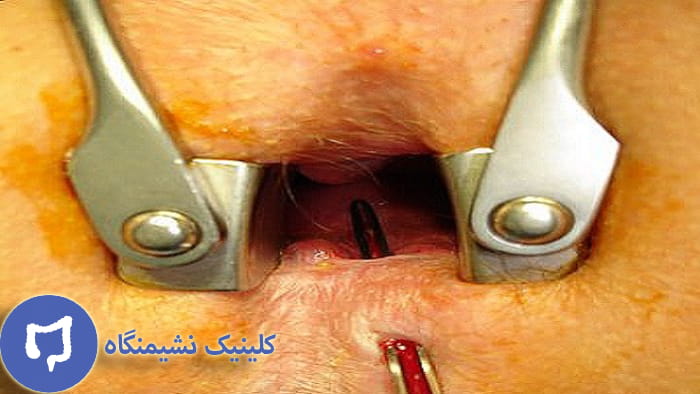 عکس درمان فیستول مقعدی پیشرفته