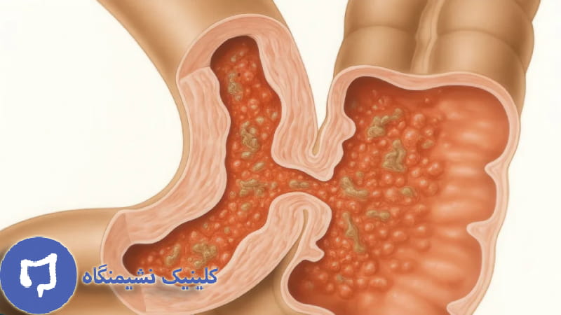 عکس انواع فیستول