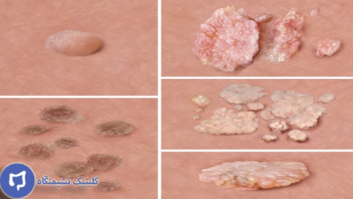 عکس انواع زگیل تناسلی