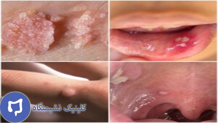 عکس عوارض ویروس hpv