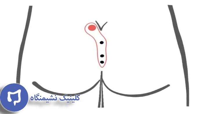 عکس فیستول مقعدی پیچیده در صورت عدم درمان