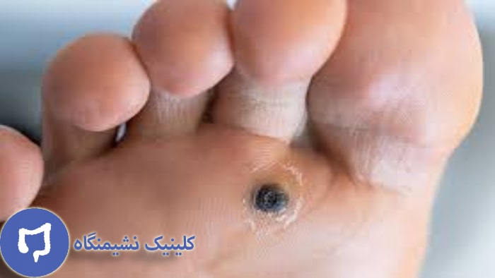 عکس زگیل پا