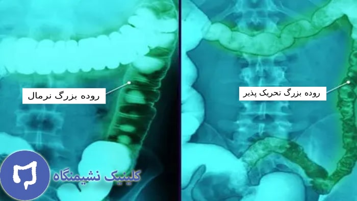 عکس سندروم روده تحریک پذیر