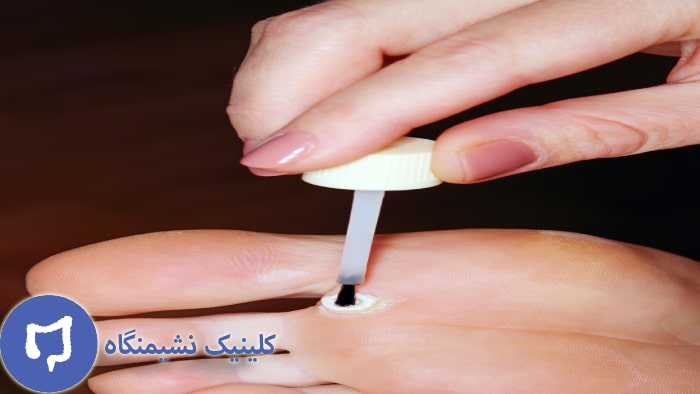 عکس الکل برای درمان زگیل تناسلی