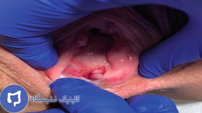 عکس فیستول واژن