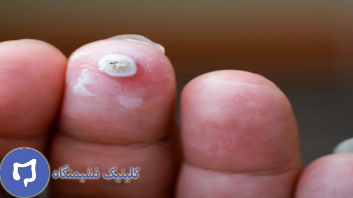 عکس درمان زگیل تناسلی با وازلین