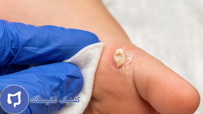 عکس نوره و حنا برای زگیل تناسلی