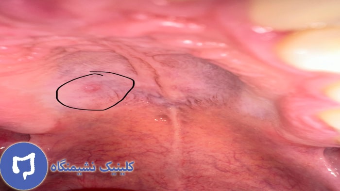 عکس زگیل دهان