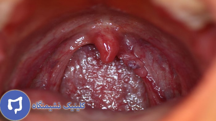 عکس زگیل حلق و گلو