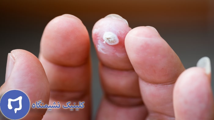 عکس زگیل انگشت دست