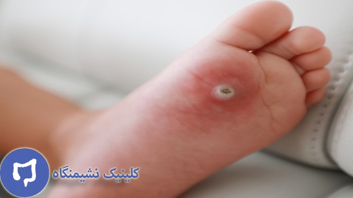 عکس از زگیل پا