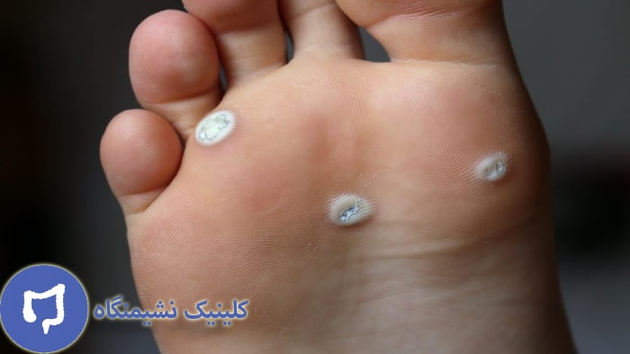 عکس زگیل کف پا