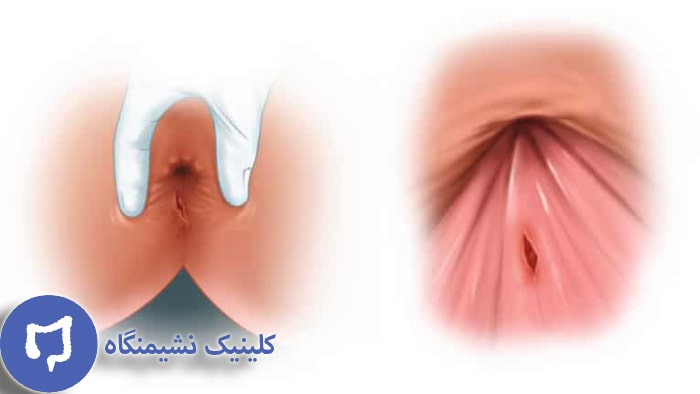 شقاق چیست با عکس