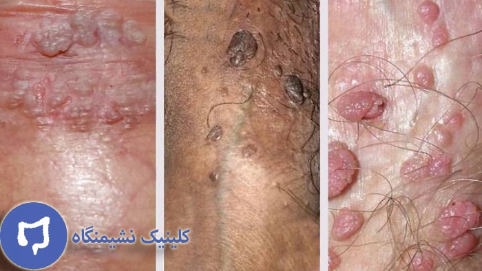 عکس زگیل تناسلی