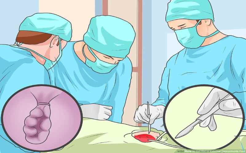 عمل جراحی بواسیر خارجی 